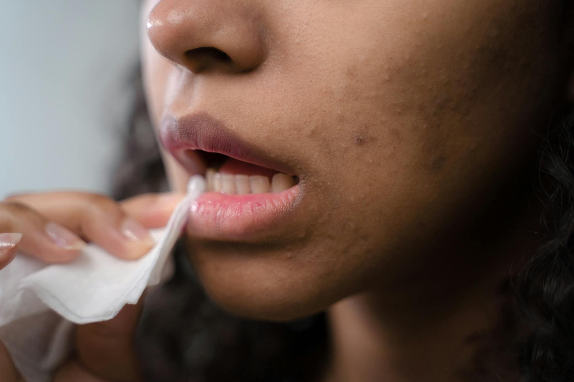 Savon d'Alep contre l'acné : ça marche vraiment ? 1 Savon d'Alep contre l'acné : ça marche vraiment ? — soins naturels artisanaux Normandie